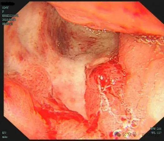 24岁女演员确诊“癌王”,崩溃痛悔:大家别像我这样