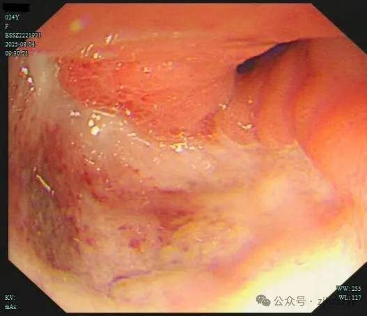 24岁女演员确诊“癌王”,崩溃痛悔:大家别像我这样