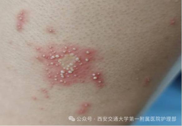 西安多区发现隐翅虫?千万别拍!毒液堪比硫酸